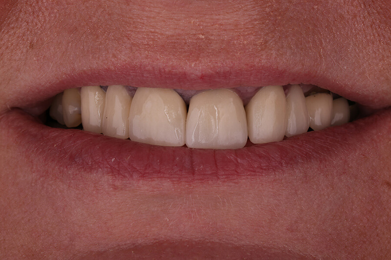 Crowns Patient 1 - Before - 1