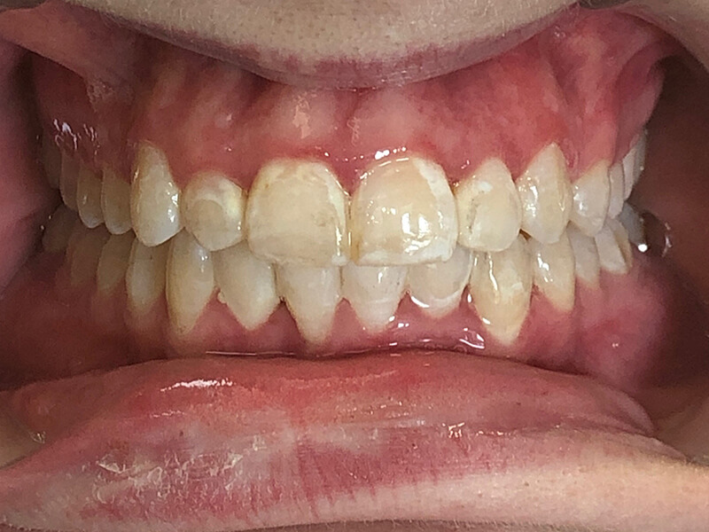 Invisalign Patient 1 - After - 1