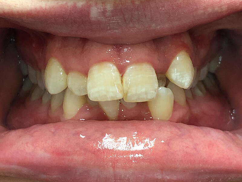 Invisalign Patient 1 - Before - 1