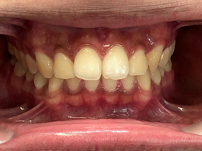 Invisalign Patient 2 - After - 1