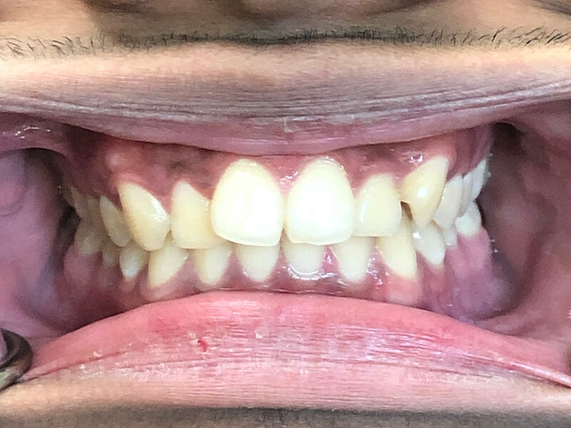 Invisalign Patient 2 - Before - 1