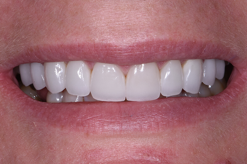 Veneers Patient 1 - After - 1