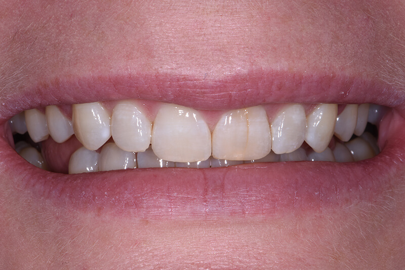 Veneers Patient 1 - Before - 1