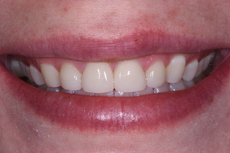 Veneers Patient 2 - After - 1