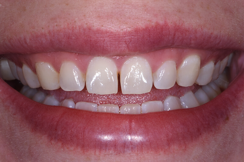 Veneers Patient 2 - Before - 1